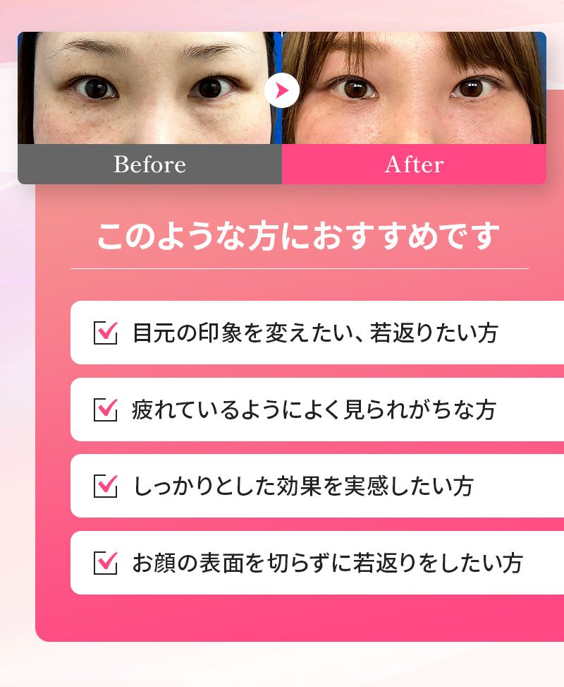 このような方におすすめです ・目元の印象を変えたい、若返りたい方 ・疲れているようによく見られがちな方 ・しっかりとした効果を実感したい方 ・お顔の表面を切らずに若返りをしたい方 7日後時点で想定以上の腫れや内出血がある場合、最大20,000円分ポイントバック 追加料金なし 再施術保証制度 クマとり後の小じわ対策付き 一度で実感できる違い・クマ取り・クマとり・目元 クマ取り・クマとり 大阪・目の下 クマ取り・クマ 取り 名医・クマ 取り 裏 ハムラ・クマ 取り 大阪・クマ 整形 大阪・裏 ハムラ 法 名医 関西・ミルクリニック・ミルクリニック 大阪・ミルクリニック 心斎橋・ミルクリニック 裏ハムラ・ミルクリニック クマ取り